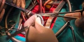 نجات جان بیمار ۸۰ ساله با تکنیک جدید تعویض دریچه قلب