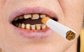 دندان سیگاری‌ها ۴ برابرِ افراد دیگر خراب می‌شود