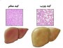 یک فوق تخصص بیماری‌های گوارش و کبد ضمن خاطرنشان کرد: چاقی و اضافه وزن به عنوان مهمترین و اولین علت ایجاد کبد چرب شناخته شده است.