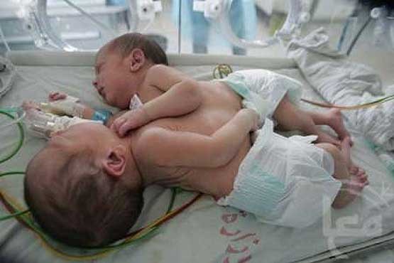 عکس: تولد نوزادان دوقلوی به هم چسبیده