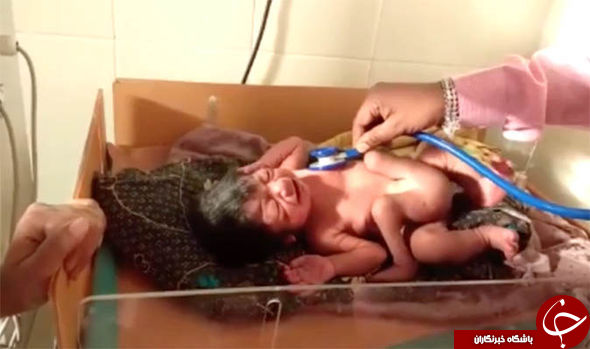 تولد نوزادی عجیب الخلقه در هندستان + تصاویر