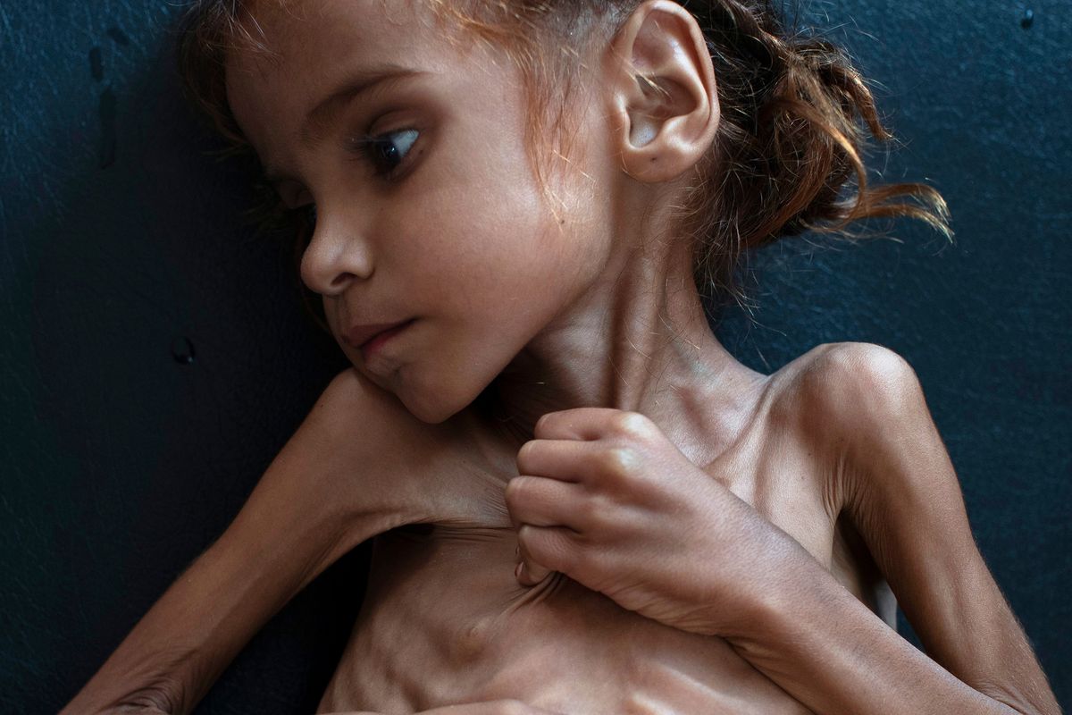 گلوب اند میل: دختری که توجه جهان را به جنگ بی‌رحمانه عربستان در یمن جلب کرد، جان باخت