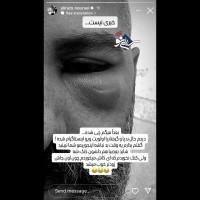 علیرام نورایی تصویر چشم ورم کرده اش را منتشر کرد + عکس