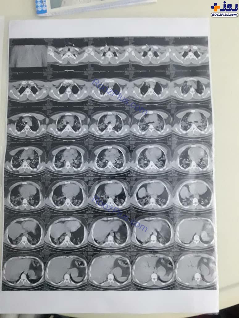 تصویری عجیب از ریه فرد کرونایی طی ۱۰ روز
