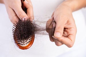 درمان معجزه‌آسای ریزش مو «تضمینی»