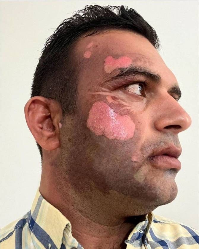 سوزاندن صورت یک محیط بان توسط یک شکارچی (+عکس)