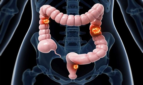 6 نشانه اولیه ابتلا به سرطان روده بزرگ