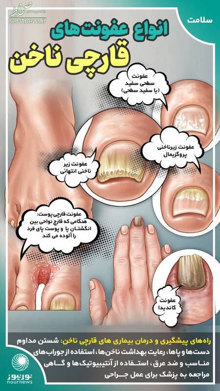 اینفوگرافی/ انواع عفونتهای قارچی ناخن اینفوگرافی