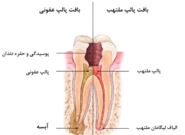 عفونت-دندان